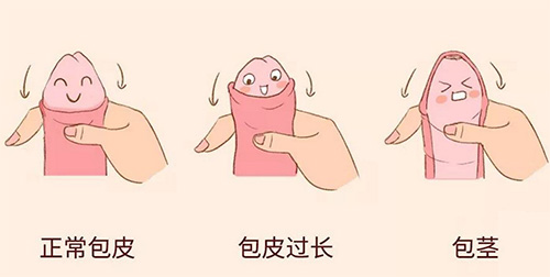 包皮过长有什么影响