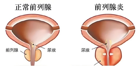 慢性前列腺炎有什么症状，慢性前列腺炎八大症状