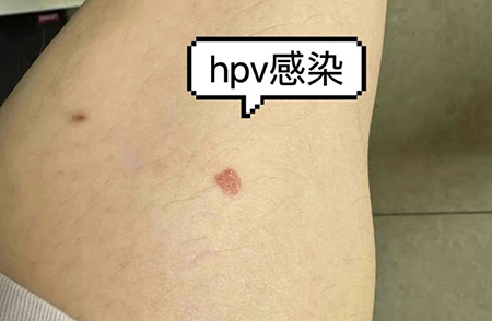 hpv男性感染后的表现，常见男性感染HPV5大症状
