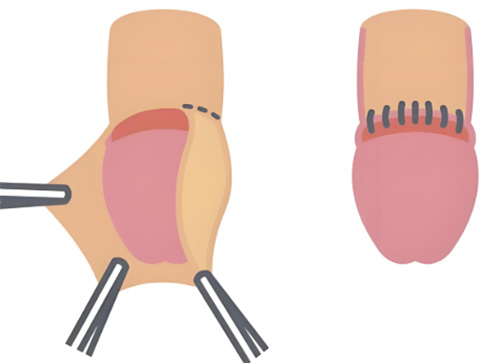 包皮手术得多长时间痊愈