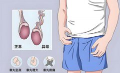 两侧睾丸大小不一样影响生育吗