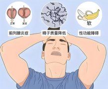 前列腺增生影响性功能吗