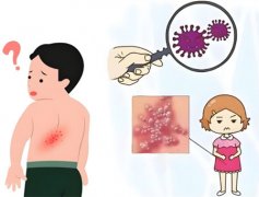 病毒性疱疹怎么治疗最快方法，几天能好