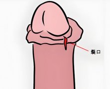 包皮裂口子是怎么回事