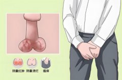 睾丸外表皮骚痒是什么原因引起的