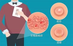 下身瘙痒怎么快速止痒