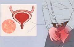 经常尿路感染反复发作怎么办