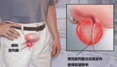 慢性前列腺炎怎样才能治愈