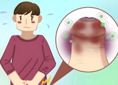 包皮肿是怎么回事?