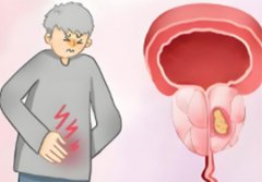 前列腺钙化灶需要治疗吗