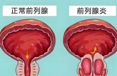 前列腺炎早期怎么治最好