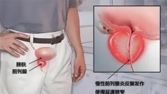 慢性前列腺炎能彻底治愈吗