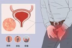 小便尿道刺痛有黄白色分泌物