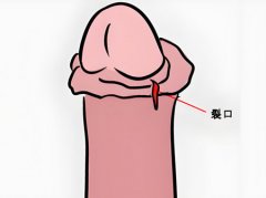 男性包皮开裂能自愈吗