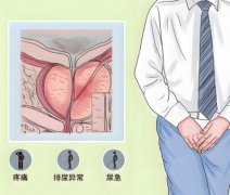 慢性前列腺炎对性功能有影响吗