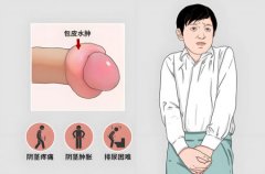 包皮突然水肿是怎么回事