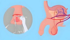 割了皮包多久恢复性正常生活