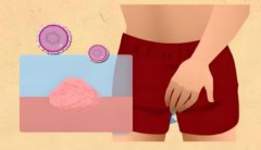 男性hpv感染怎么治疗彻底治愈