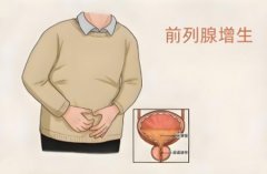 前列腺增生严重吗