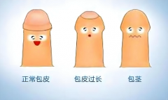 什么样的情况下需要割包皮