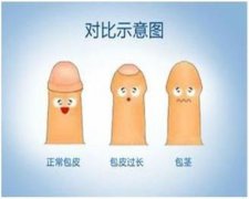 包皮手术前需要做哪些准备