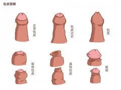 男人龟头比较敏感怎么回事