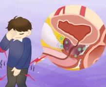 非细菌性前列腺炎可能并发哪些疾病