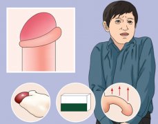 包茎手术需要多长时间