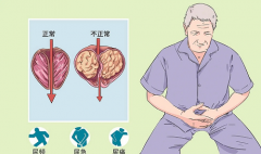 引起前列腺炎的具体因素有哪些