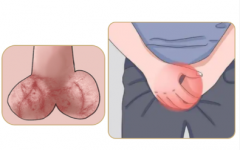 睾丸疼痛是怎么引起的