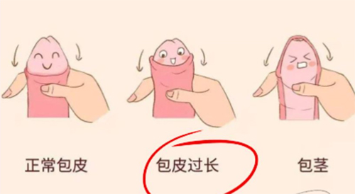 包皮太长会影响早射吗