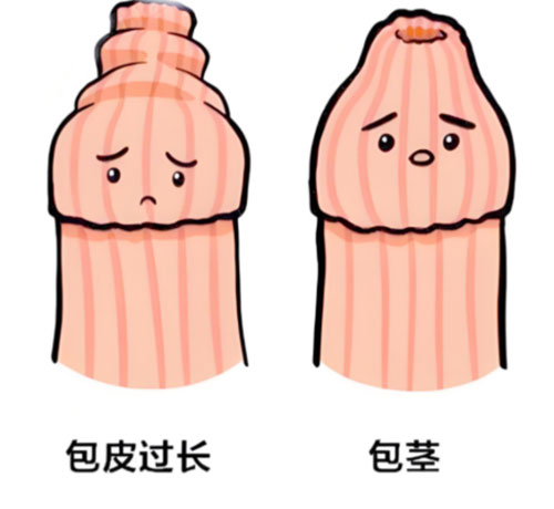 包皮太长会影响发育吗