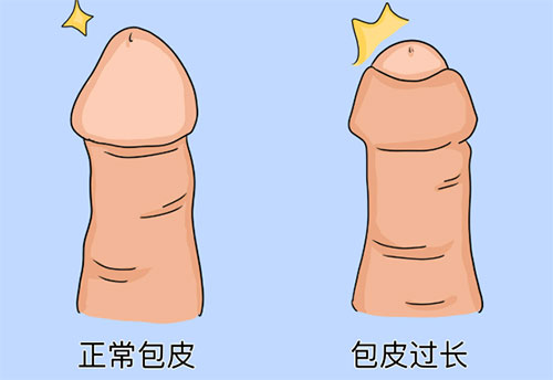 包皮太长怎么改善