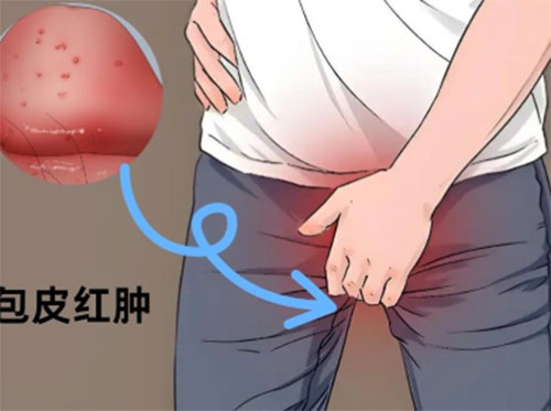 包皮肿痛怎么消除