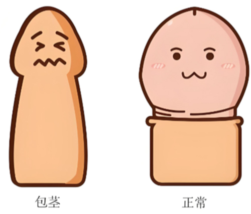 包茎什么症状