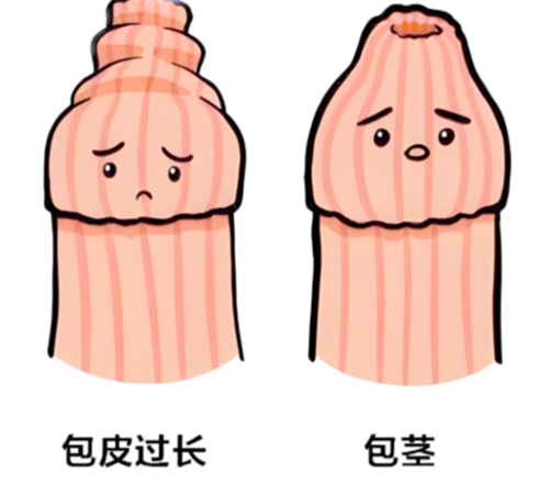 包皮太长翻不出来怎么回事