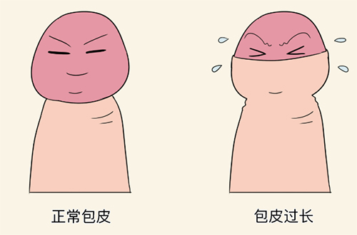 包皮太长了必须要割吗