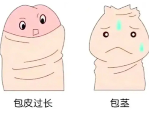 包茎什么时候手术为好