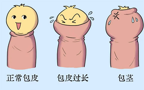 包茎会导致变短吗