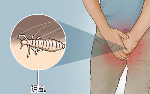 男人阴虱是怎么引起的