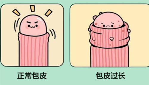包皮太长了可以不割吗